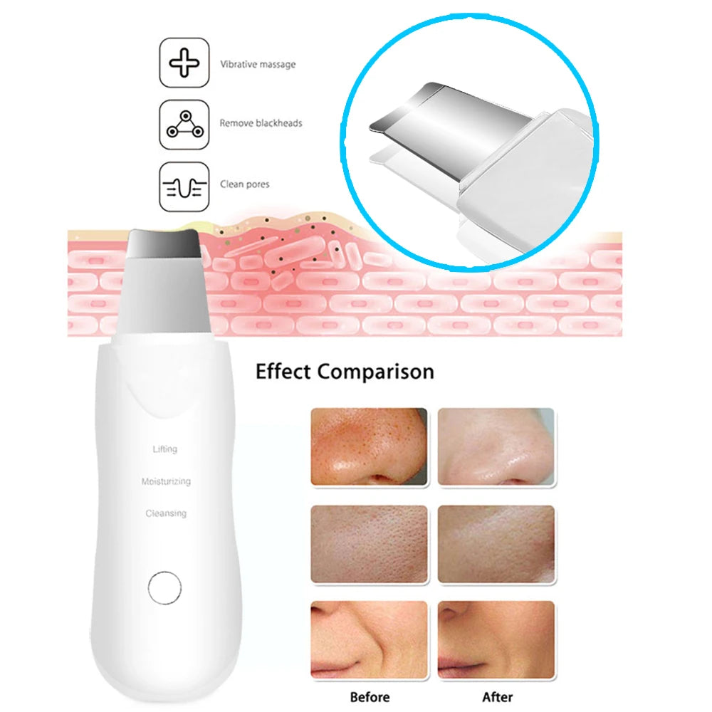 Ultrasonic Blackhead Remover Cleaner - Vivian