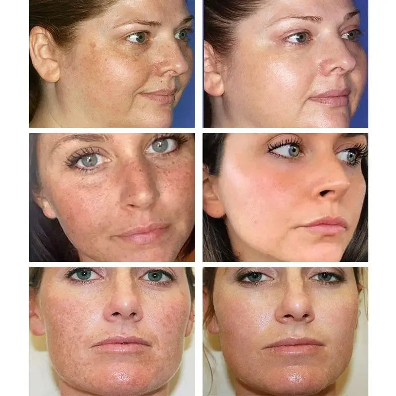 Freckle whitening cream, melasma and dark spots removal - Vivian